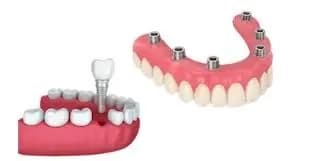 Imágenes de servicio de Odontología Arguello 4