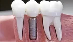 Imágenes de servicio de Odontología Arguello 5